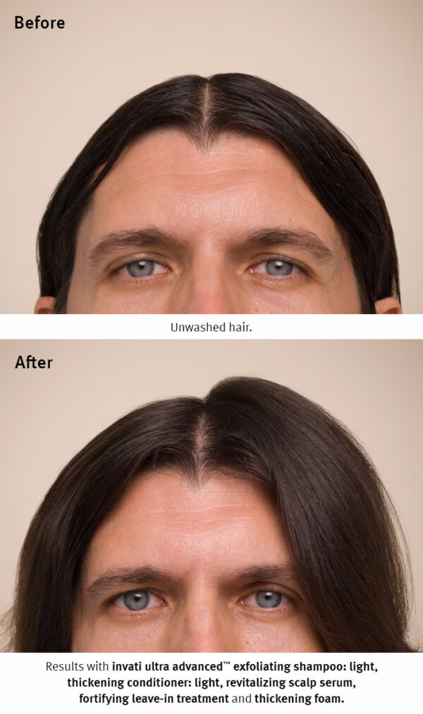 Before and after images of a person's hair. The before image shows unwashed hair, while the after image portrays thicker and healthier-looking hair, thanks to the use of Invati advanced scalp revitalizer. - SAAB Salon Spa | Ottawa On, Canada