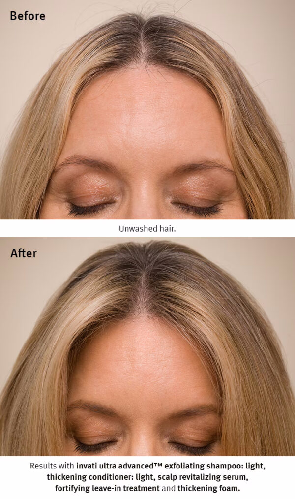 Before and after images of a person's scalp, showing noticeable hair thickening and improved hair density after using Invati Ultra Advanced Thickening Conditioner - Light. The "Before" image is labeled "Unwashed hair. - SAAB Salon Spa | Ottawa On, Canada